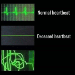 Meme Generator – Normal Heartbeat, Deceased Heartbeat
